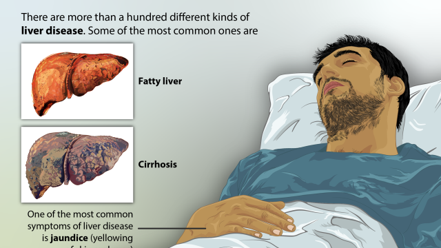 Depiction of a person suffering from LIVER DISEASE. The common types of liver disease have been shown.