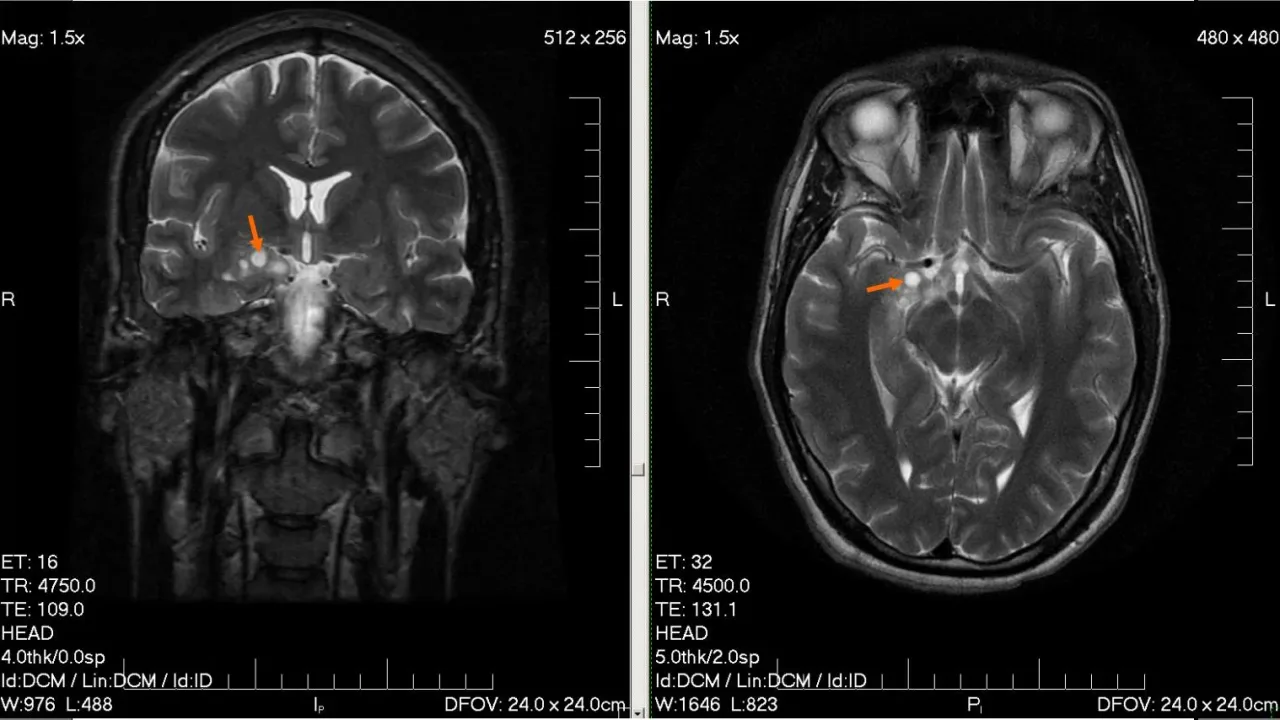 MRI glioma 28 yr old male